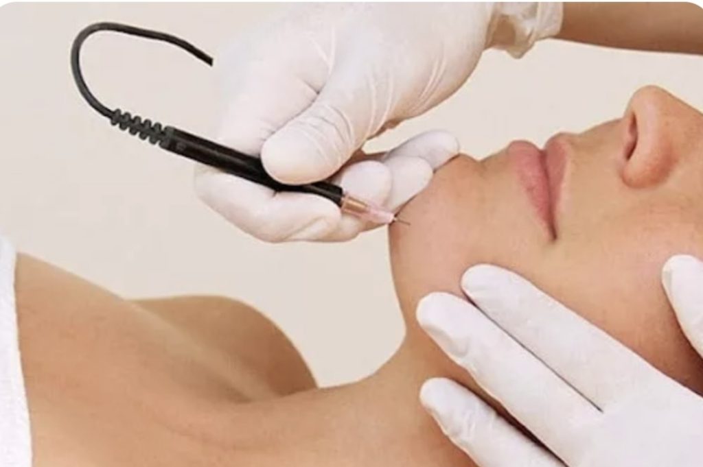 Traitement d’épilation électrique